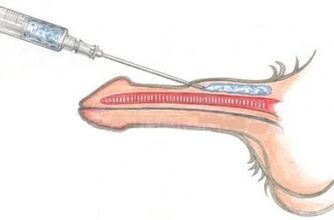A dangerous method of penis enlargement using petroleum jelly injections